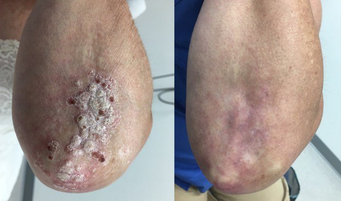 psoriasis healing process