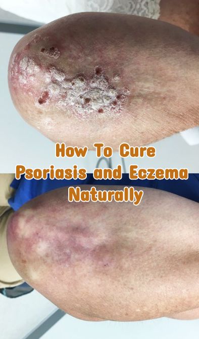 eczema and psoriasis nature cure